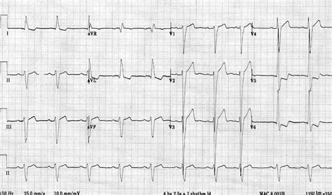 heart lv|life expectancy with lvh.